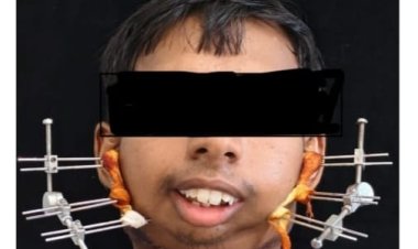 सिम्स में 24 वर्षीय युवक के बचपन से बंद जबड़े का सफल ऑपरेशन